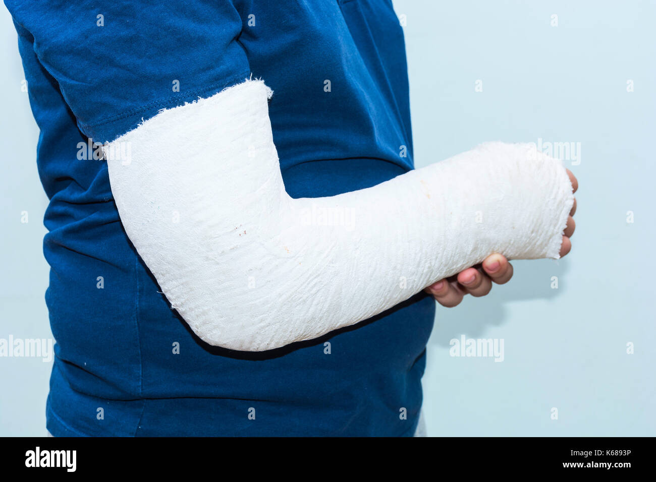 Boy with broken arm, plaster on arm as therapy. Close up of a young man's white long arm plaster / fiberglass cast covering the wrist, arm, and elbow  Stock Photo