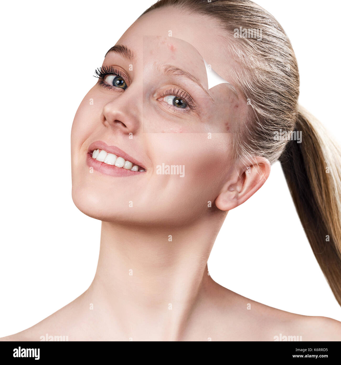 Woman face before and after treatment skin. Stock Photo