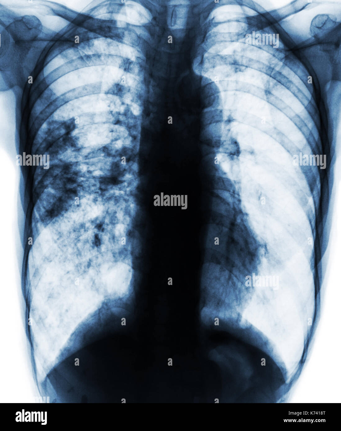 Pulmonary tuberculosis . Film x-ray of chest show patchy infiltrate at right lung due to TB infection . Stock Photo