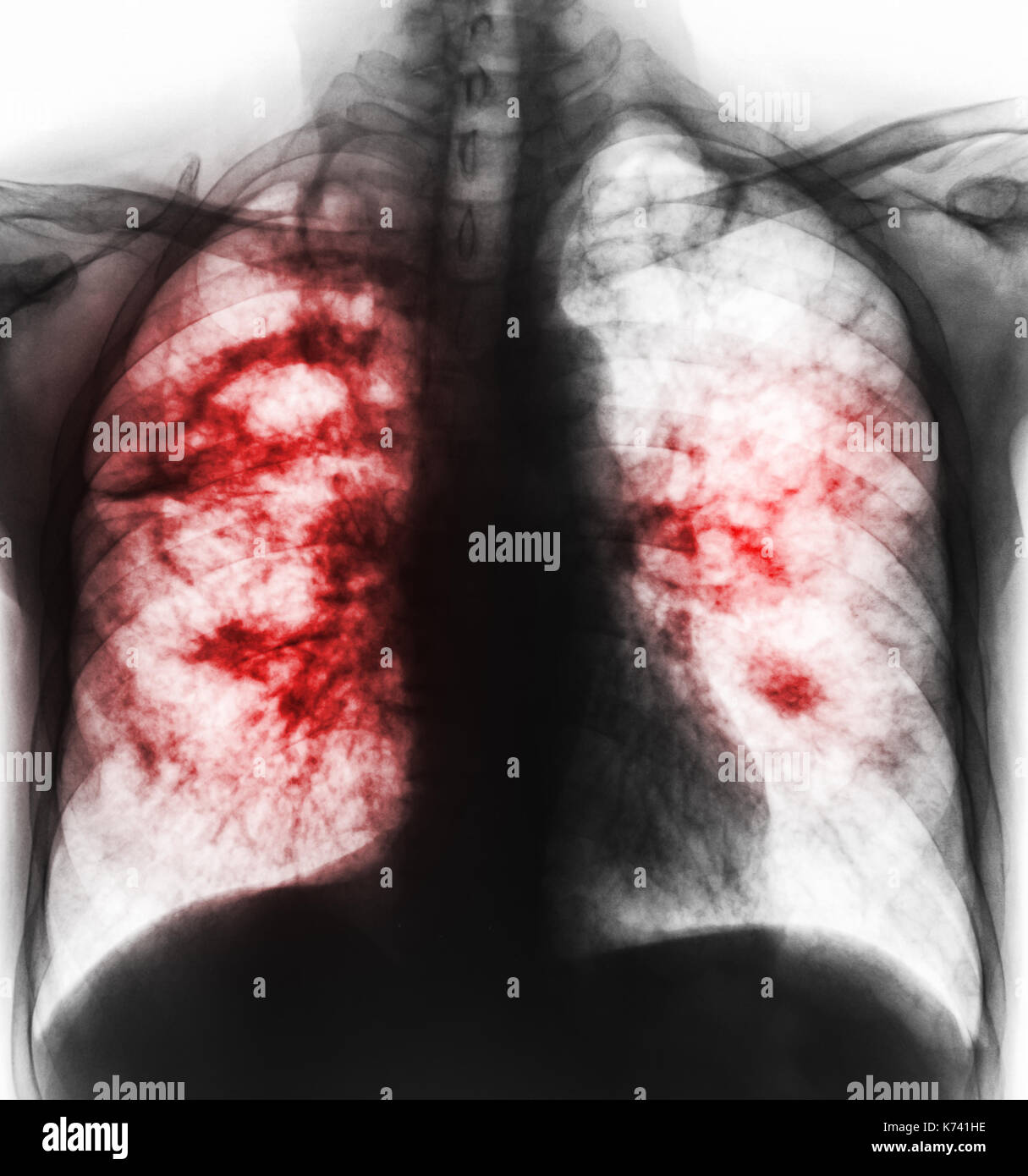 Pulmonary tuberculosis . Film x-ray of chest show cavity at right Stock