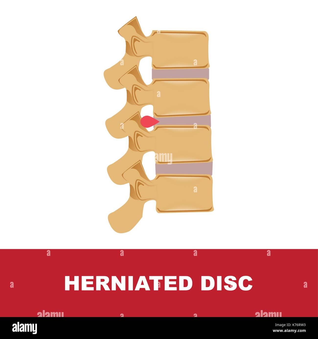 human disc degeneration. degeneration with herniated disc Stock Vector