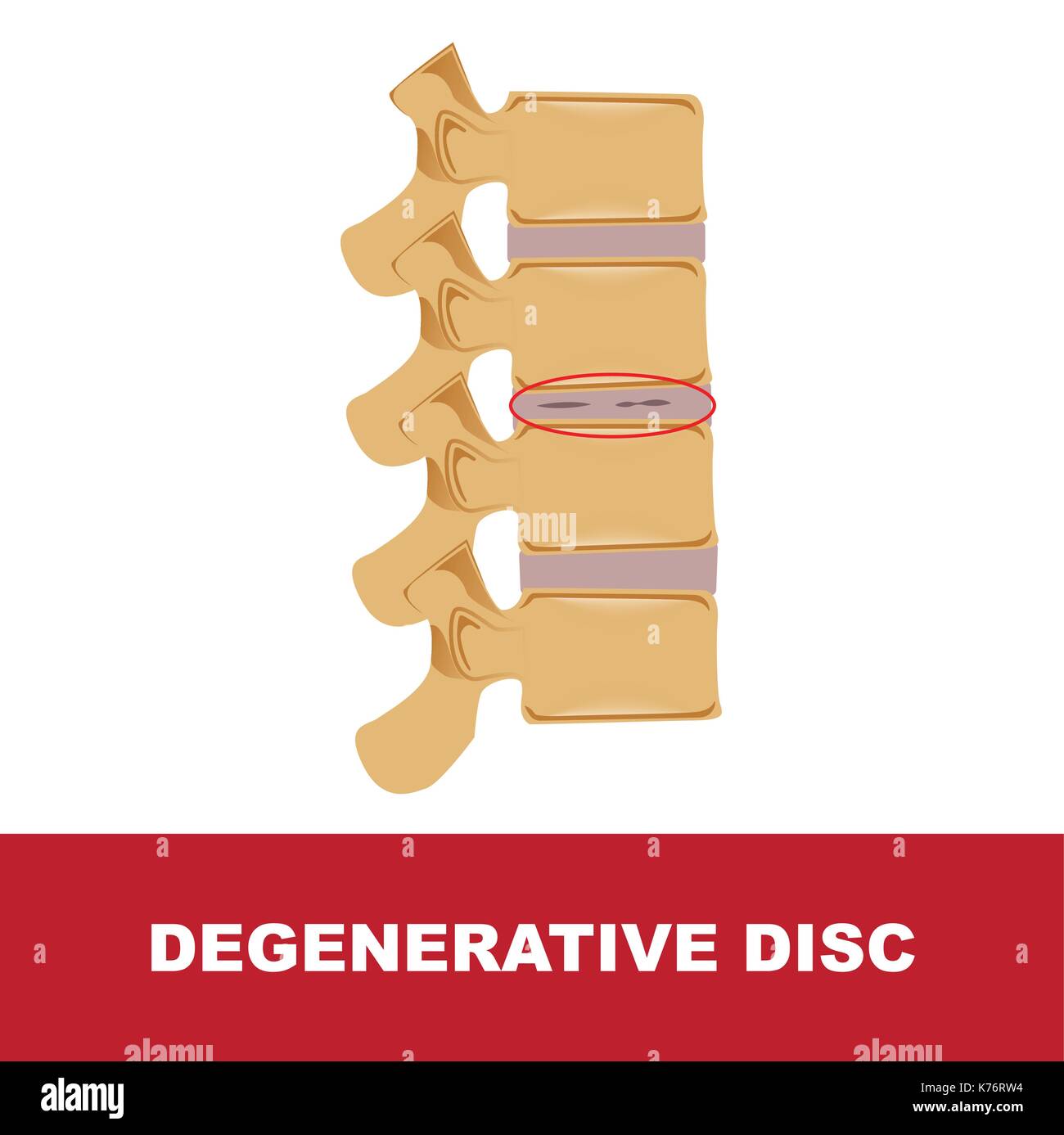 Degenerative Disc Disease Stock Photos & Degenerative Disc Disease