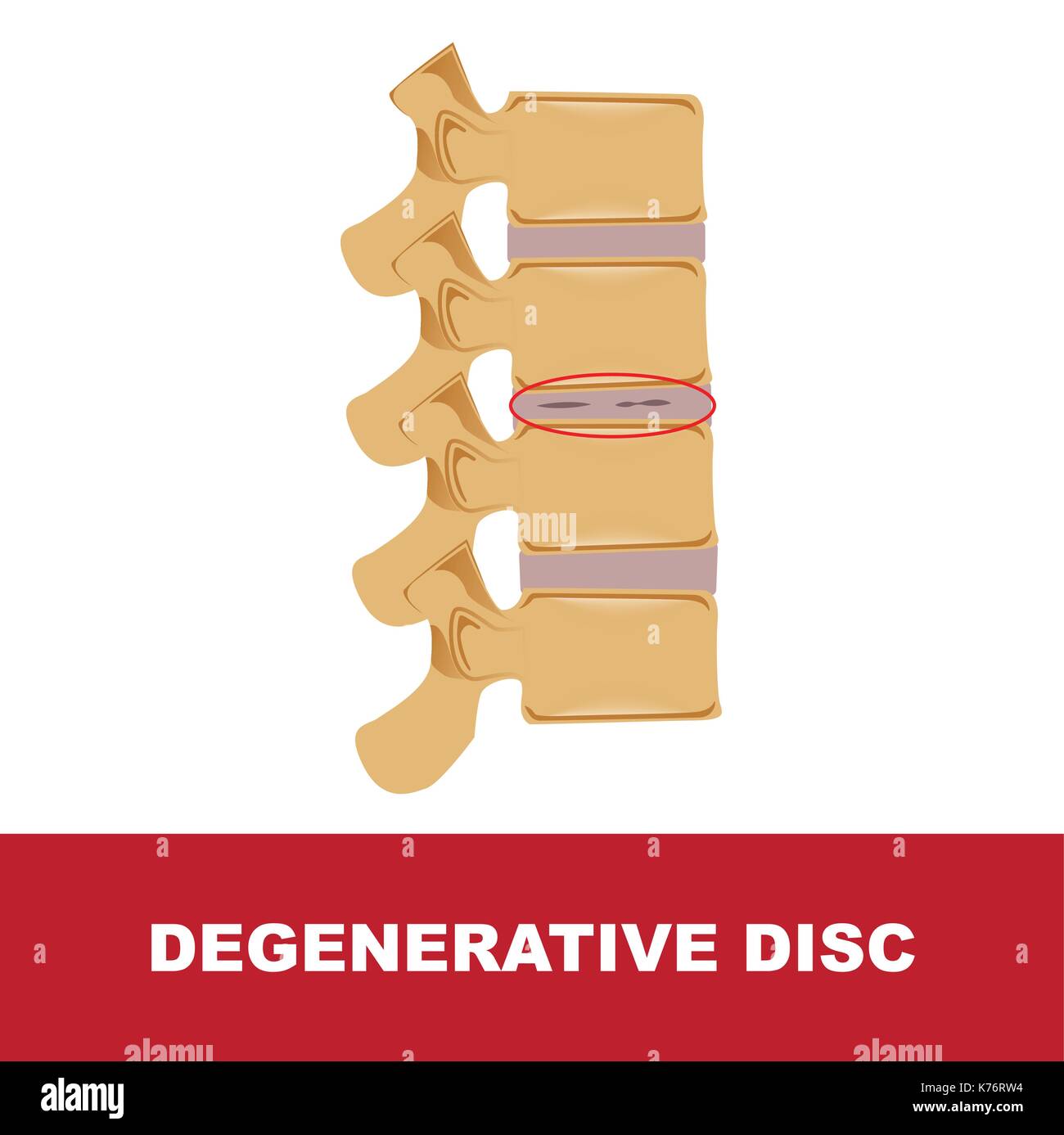human disc degeneration. degeneration with degenerative disc Stock Vector