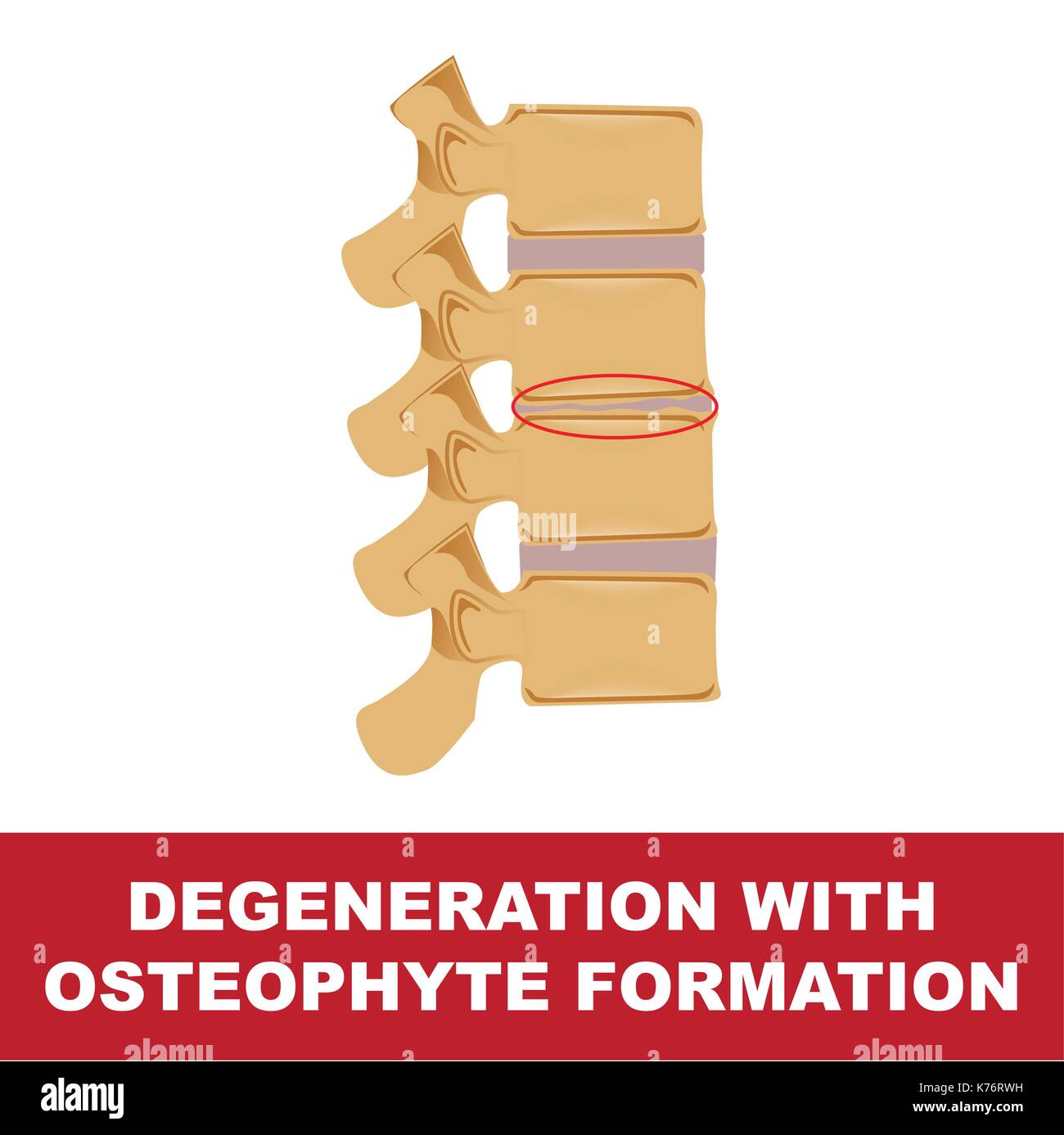 human disc degeneration. degeneration with osteophyte formation. vector format illustration. Stock Vector