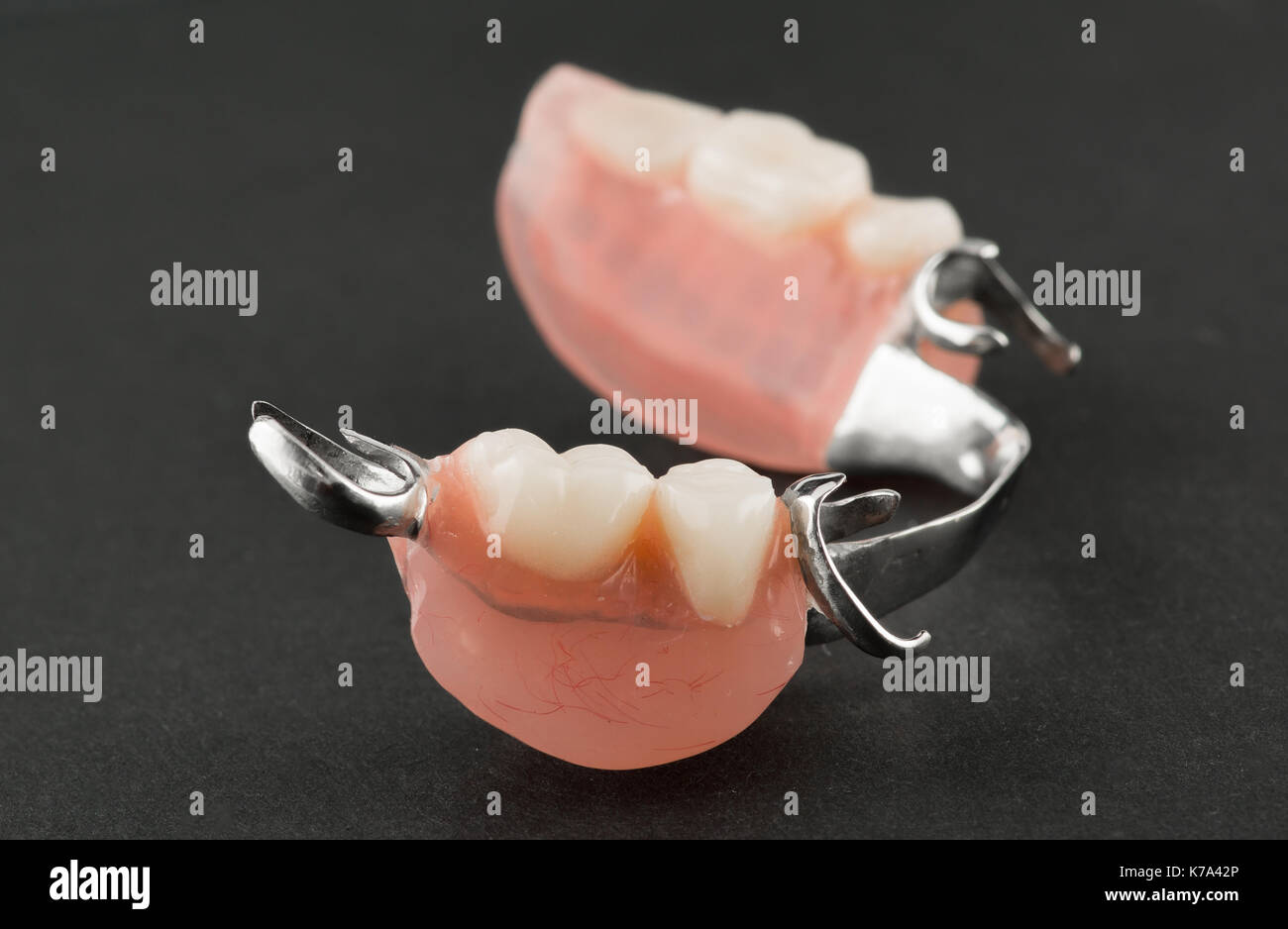 Clasp prosthesis for upper jaw Clasp prosthesis for upper jaw
