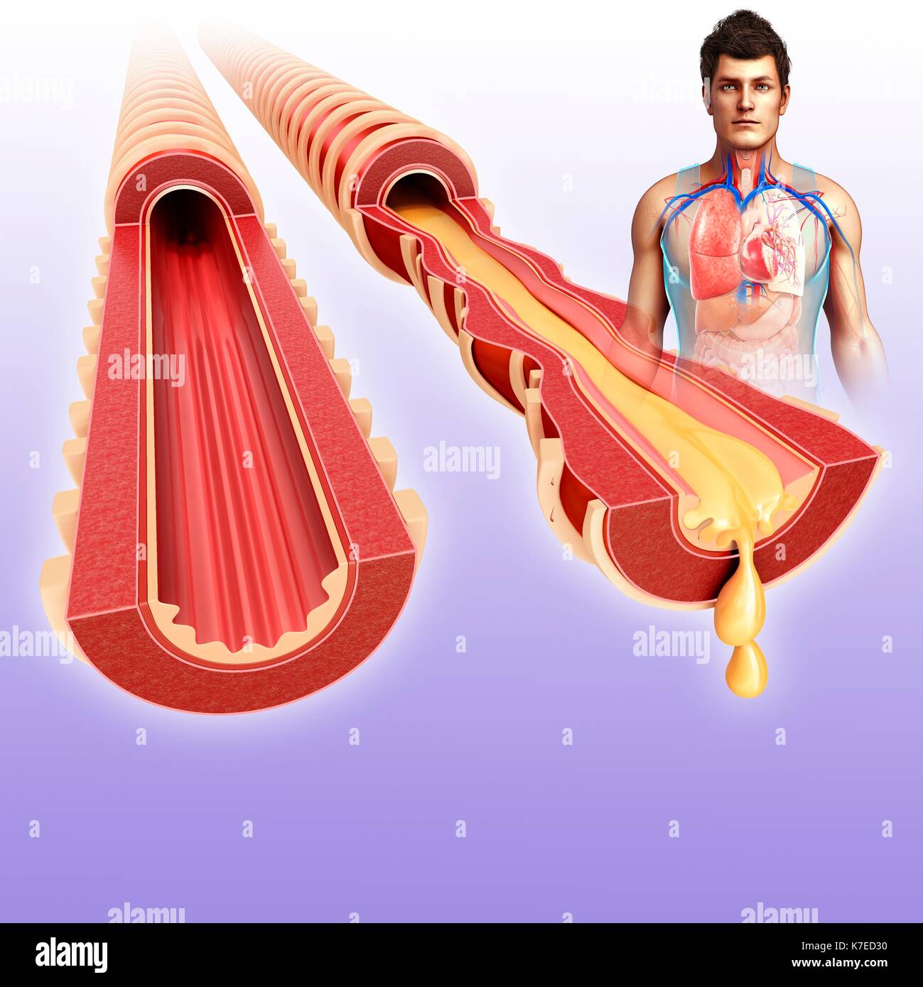 Illustration of a man's normal and infected bronchi. Stock Photo