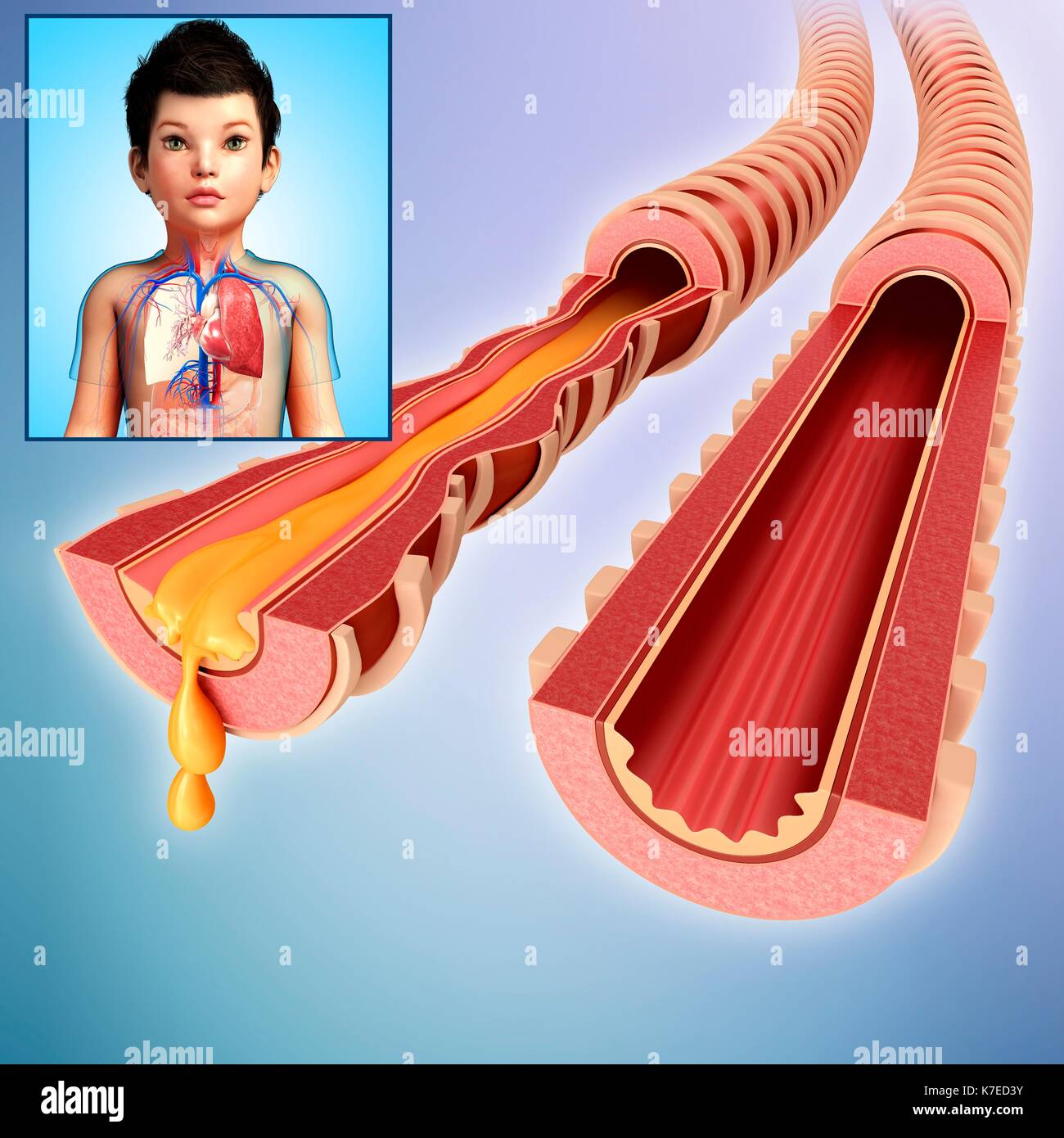 Illustration of a child's infected and normal bronchi. Stock Photo