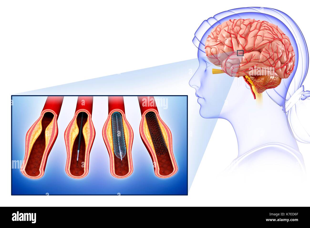 Illustration of brain stent angioplasty to treat and prevent a stroke Stock Photo Alamy