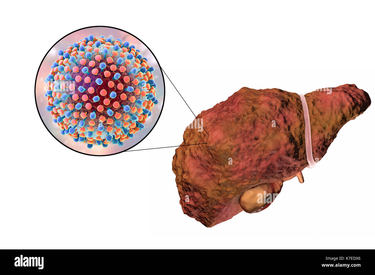 Computer illustration showing a cirrhotic liver and a close-up of hepatitis C viruses. Hepatitis C is a common cause of chronic hepatitis which progresses to liver cirrhosis. Viruses cause cell death (necrosis) in the hepatic lobules, which leads to scarring. This causes the liver surface to appear rough and lumpy instead of the usual smooth healthy appearance. The disease is irreversible and may lead to liver carcinoma. Stock Photo