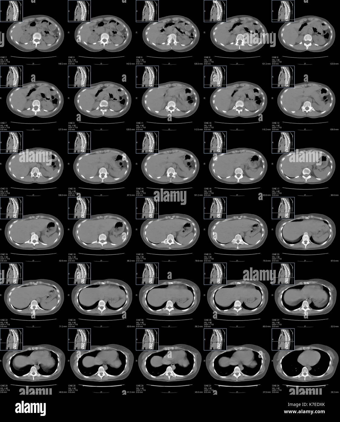 Abdomen and chest anatomy. Series of computer tomography (CT) scans of transverse sections through the upper part of the abdomen and the lower part of chest of a 30 year old patient. They show the liver (left), bowels (right), spine (bottom), kidneys (bottom left and right), heart (top in last line of images) and lower lobes of lungs (black in last line of images). Stock Photo