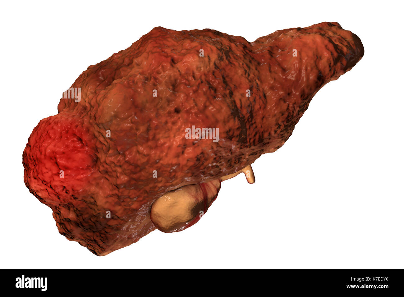 Cirrhotic liver with hepatocellular carcinoma, computer artwork. One of the causes of hepatocellular carcinoma is viral infection, particularly with hepatitis C viruses (HCV). Hepatitis C is a common cause of chronic hepatitis which progresses to liver cirrhosis. Viruses cause cell death (necrosis) in the hepatic lobules, which leads to scarring. This causes the liver surface to appear rough and lumpy instead of the usual smooth healthy appearance. The disease is irreversible and may lead to liver carcinoma. Stock Photo