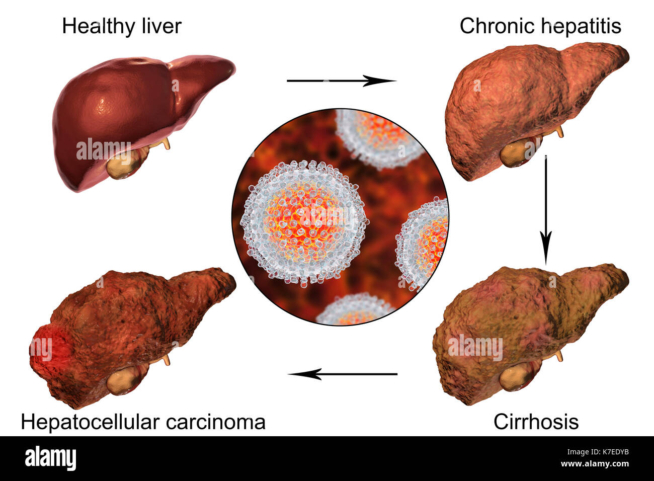 pathophysiology of hepatitis c pdf