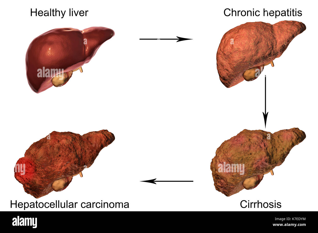 Human liver showing stages of liver disease, computer illustration. Stock Photo