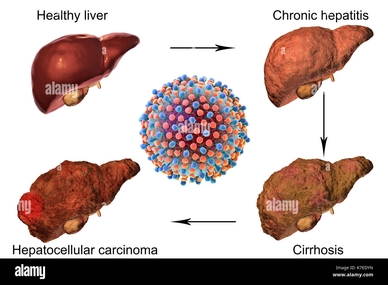 Hepatitis c liver disease