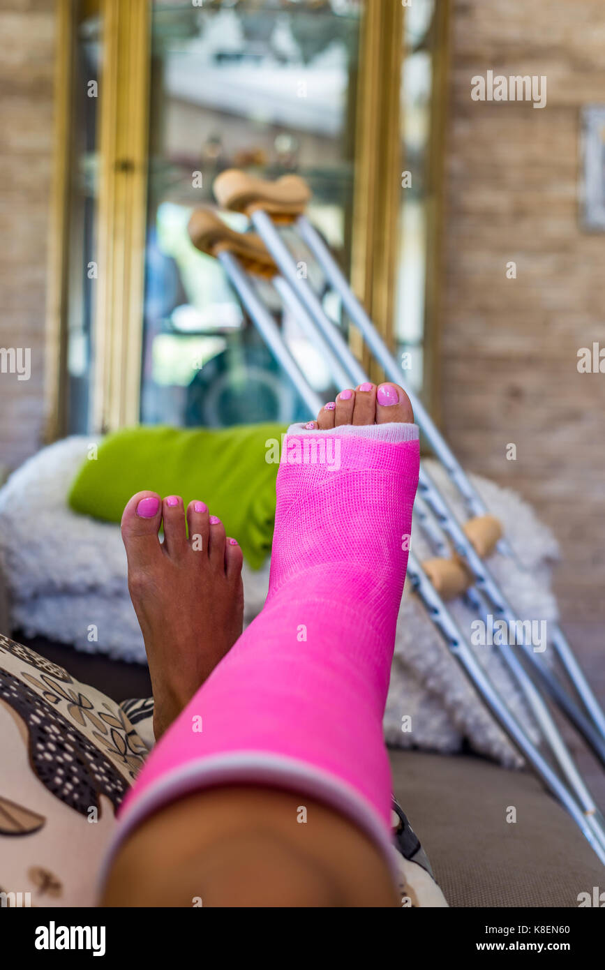 Broken leg cast hi-res stock photography and images - Alamy