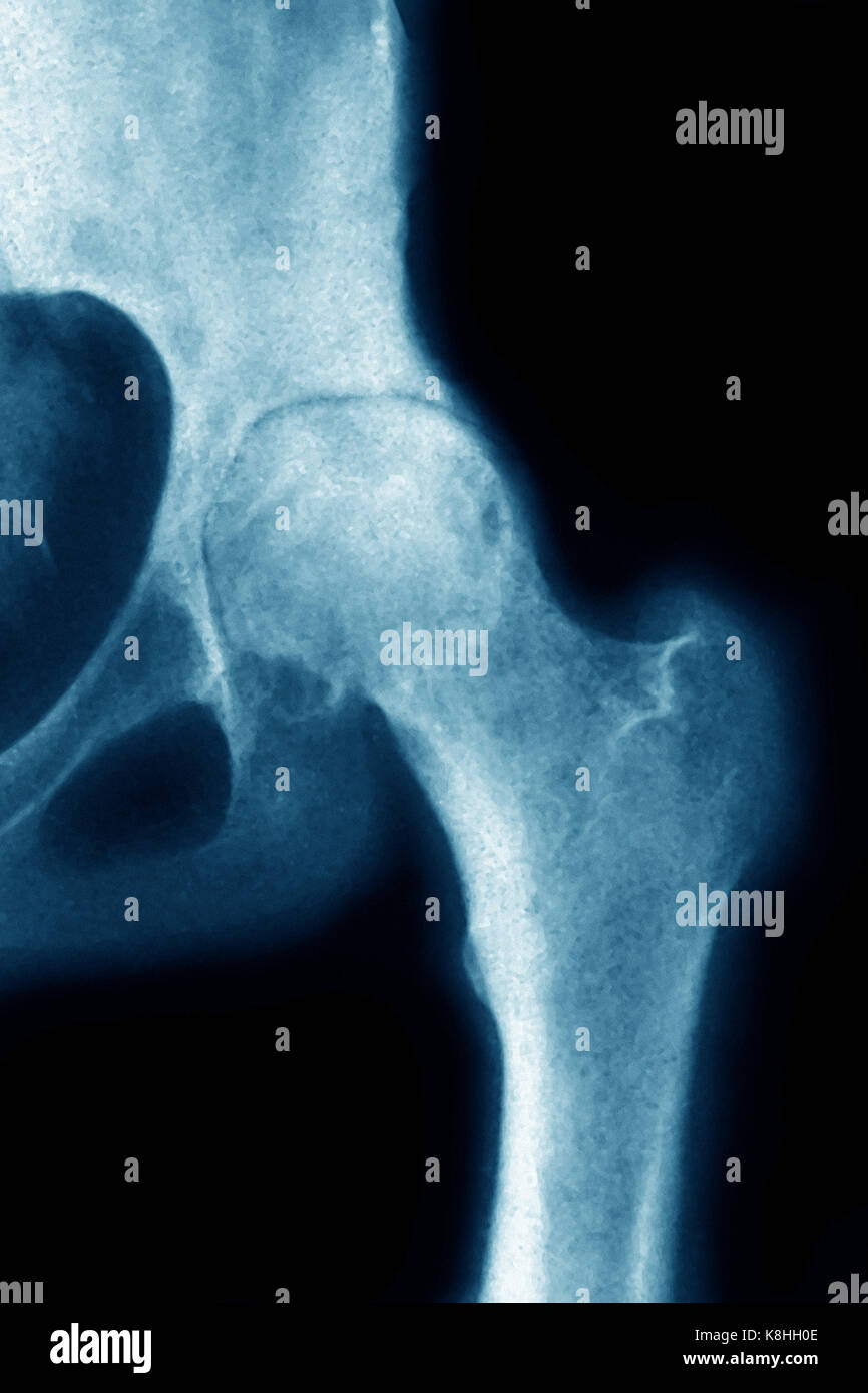 Hip osteoarthritis x ray hires stock photography and images Alamy