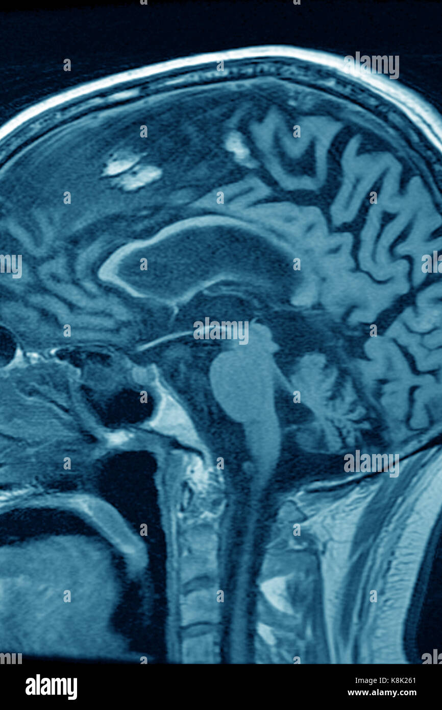 CEREBRAL ATROPHY, MRI Stock Photo: 160229385 - Alamy