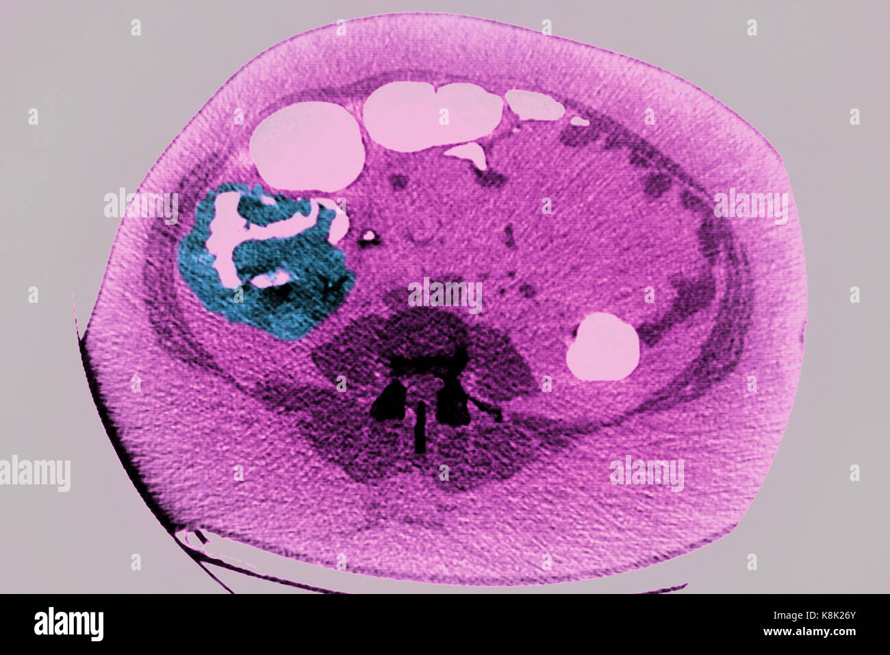 COLON CANCER CT SCAN Stock Photo - Alamy