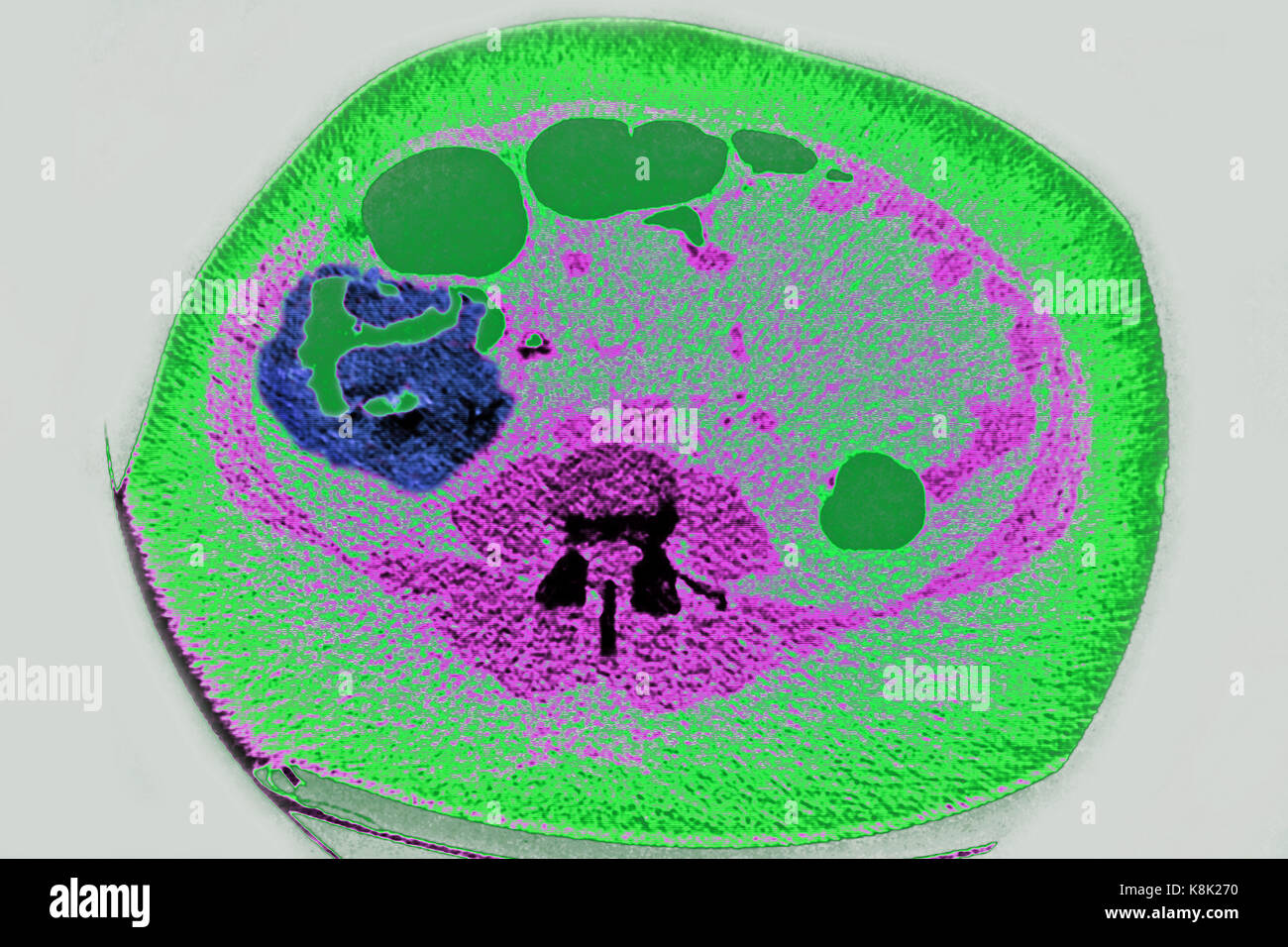 COLON CANCER CT SCAN Stock Photo - Alamy