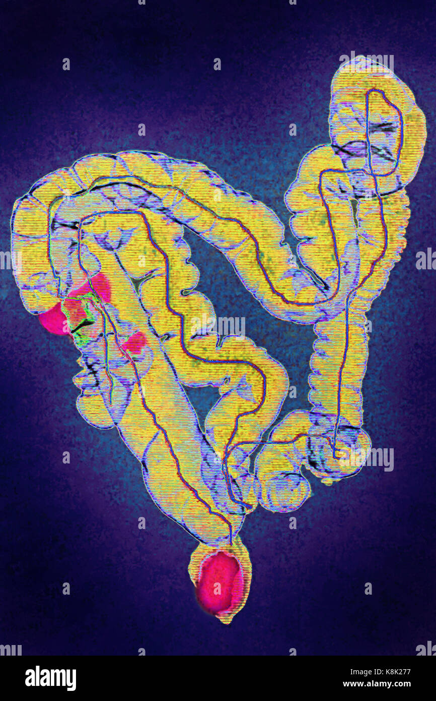 COLON CANCER CT SCAN Stock Photo - Alamy