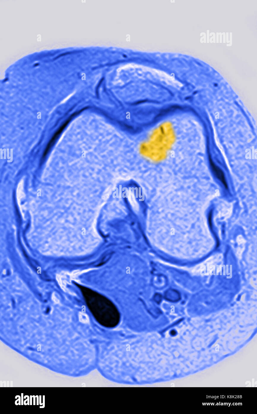 OSSEOUS EDEMA MRI Stock Photo Alamy