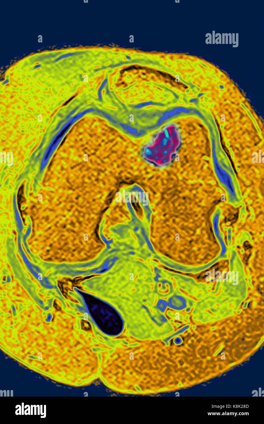 OSSEOUS EDEMA MRI Stock Photo Alamy