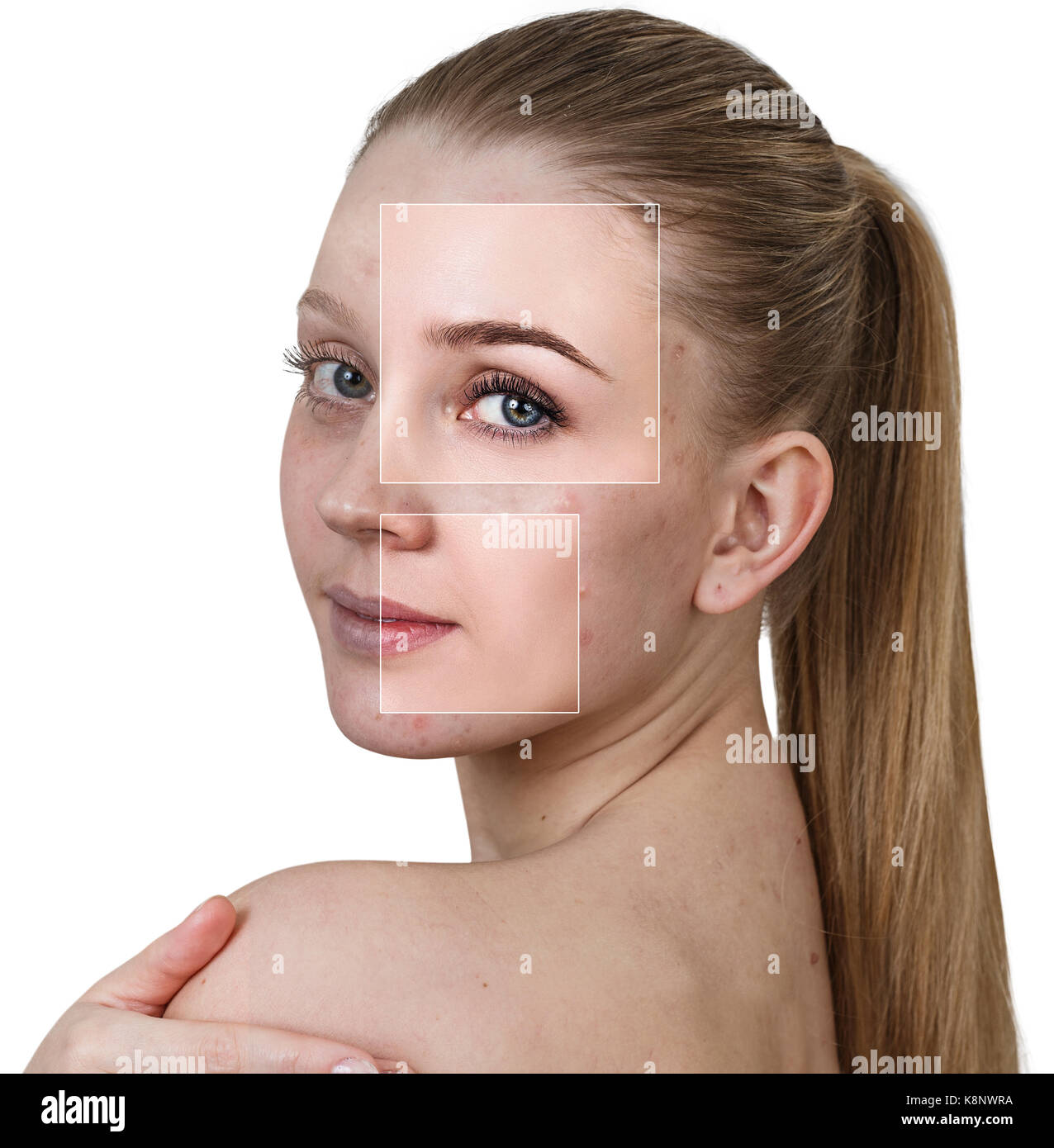 Woman's face before and after treatment Stock Photo Alamy