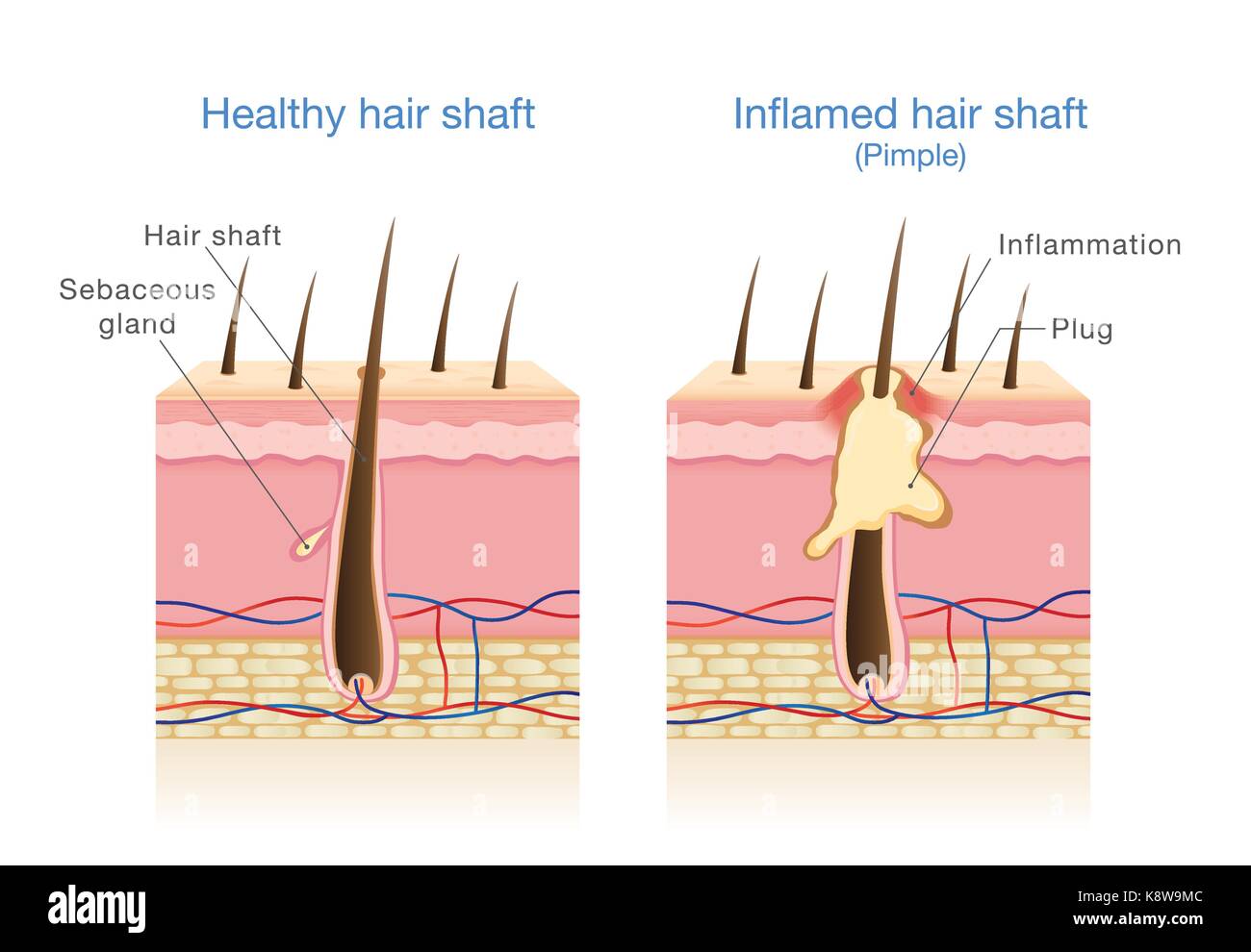 Folliculitis hi-res stock photography and images - Alamy Folliculitis hi-res stock photography and images - Alamy