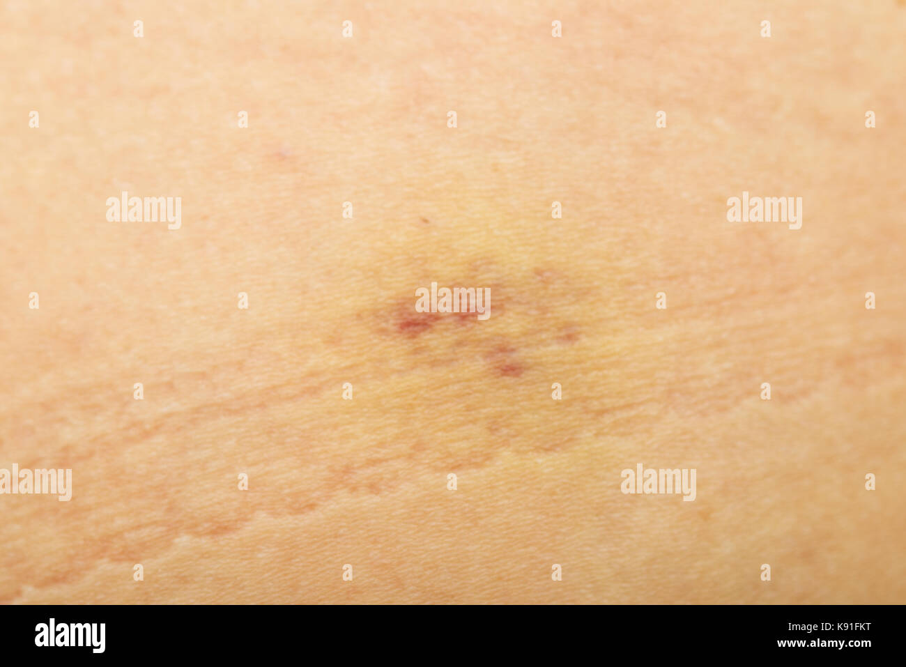 bruises after injection Stock Photo Alamy
