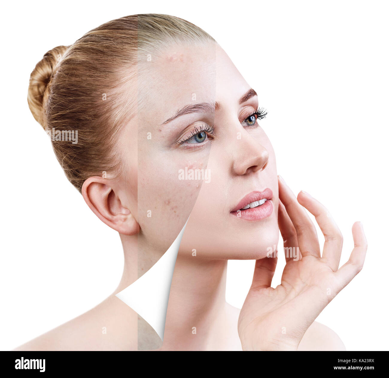 Woman face before and after treatment. Stock Photo