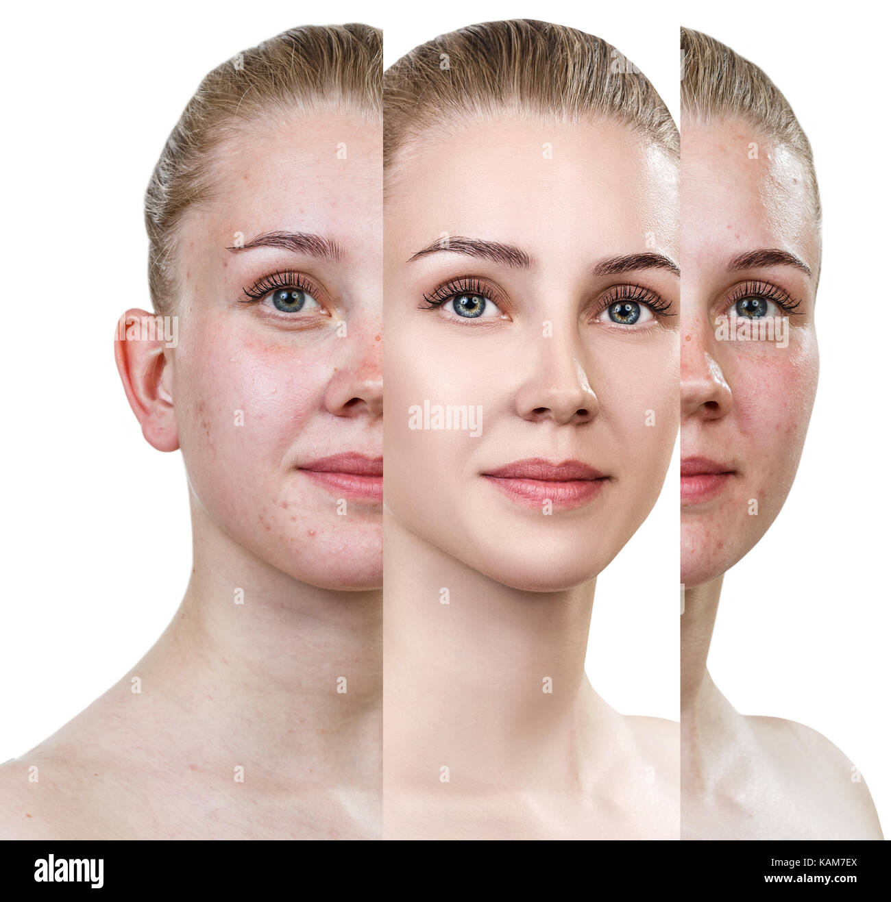 Woman with problem skin. Stock Photo