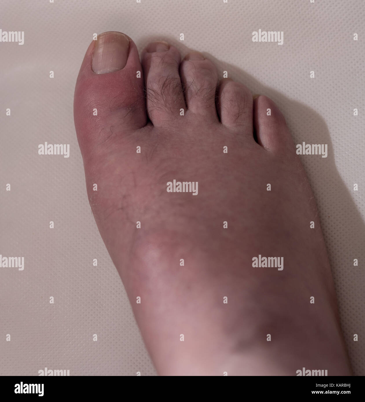 Big toe with gout, typical swelling, inflamation and skin peeling Stock Photo