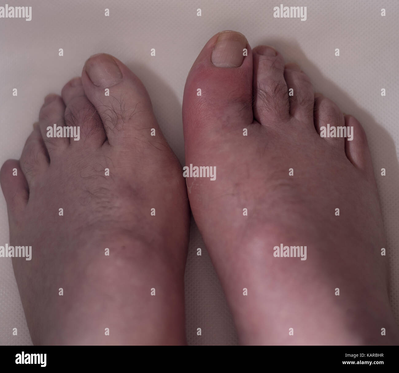 Big toe with gout beside normal big toe Stock Photo