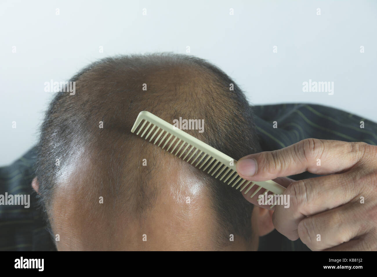 Head of man lose one's hair, glabrous on his head for elderly man Stock Photo