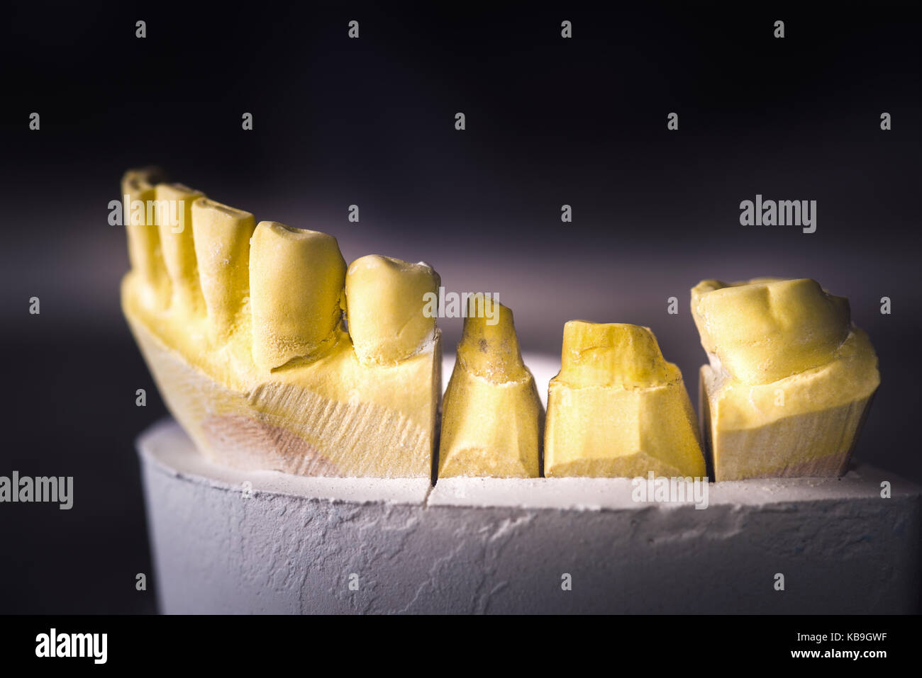 Dental prosthesis, artificial tooth. Photo of artificial teeth made in