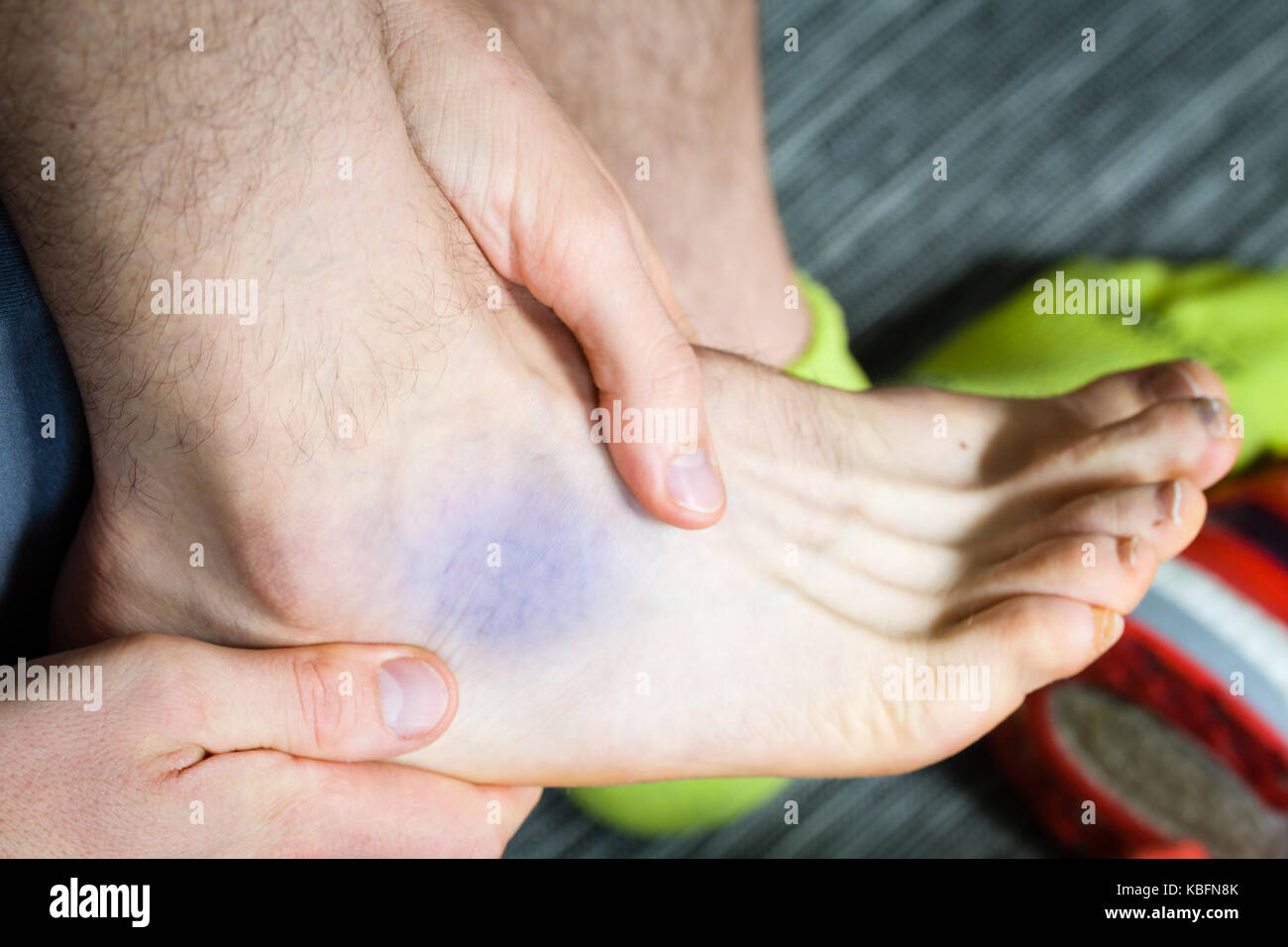 Contusion Stock Photos & Contusion Stock Images Alamy