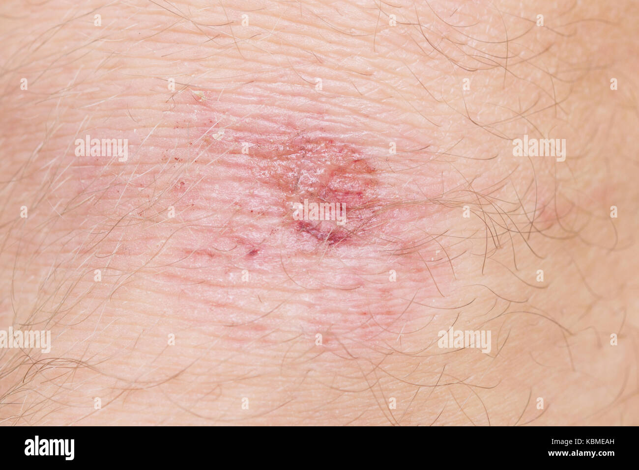 Scraped knee hires stock photography and images Alamy