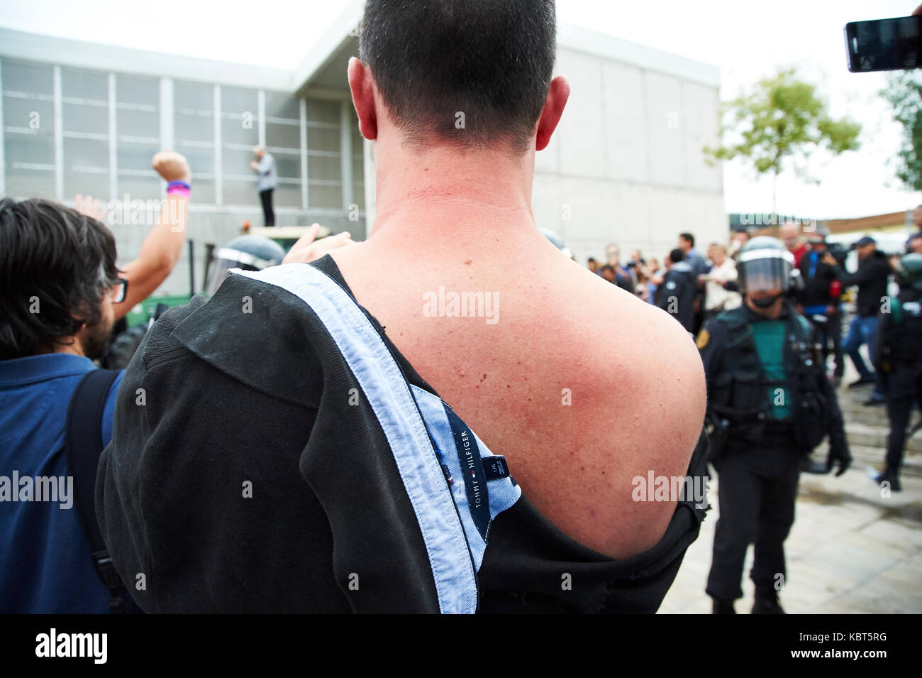 Girona, Spain. 1 October, 2017. A man injured by the Guardia Civil at Sant Julia de Ramis, place of vote of the catalan president Carles Puigdemont. The Guardia Civil charge against the people impeding that makes a vote. The referendum has been deemed illegal by the Spanish government in Madrid Credit: Pablo Guillen/Alamy Live News Stock Photo