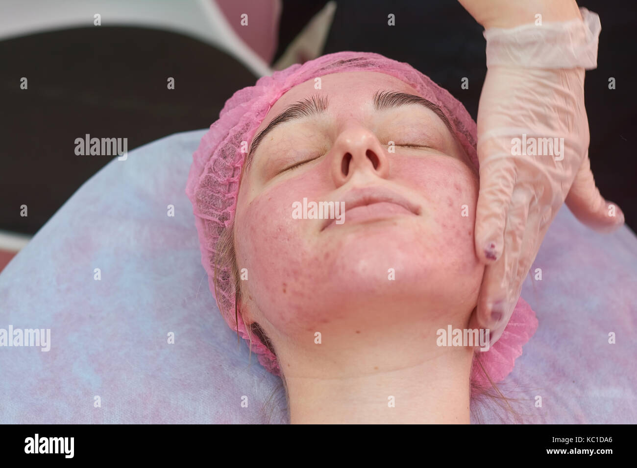 Hand of cosmetician, problematic skin. Stock Photo