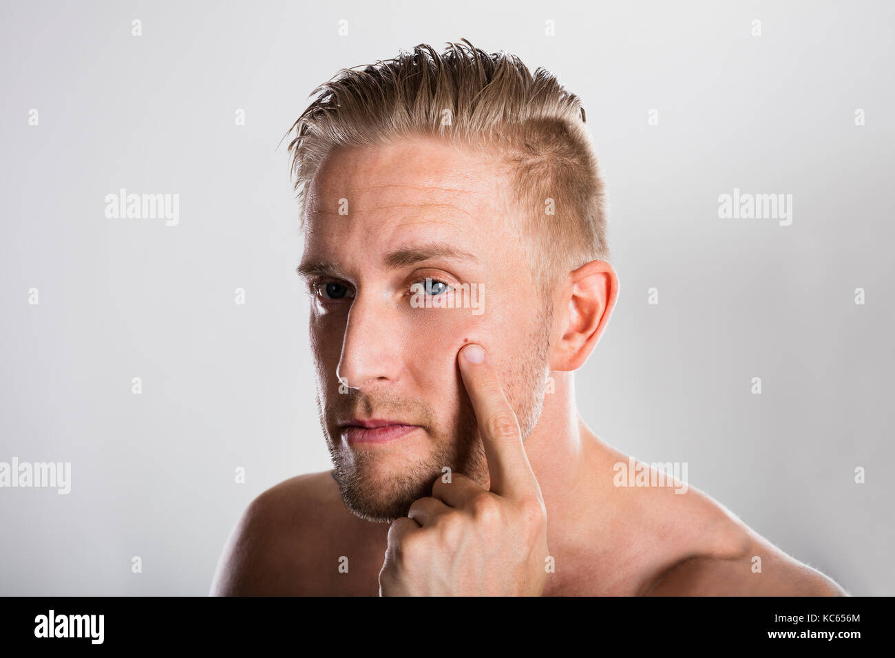 Man Squeezing Pimple On His Face. Acne Skin Problem Stock Photo