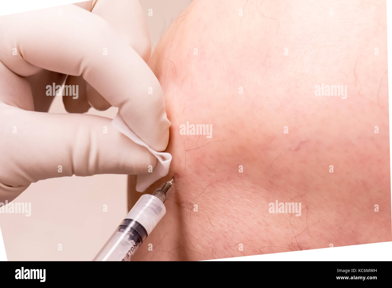 knee injection of prp Stock Photo