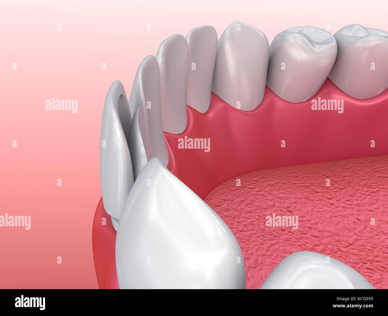 Dental Veneers Porcelain Veneer installation Procedure. 3d