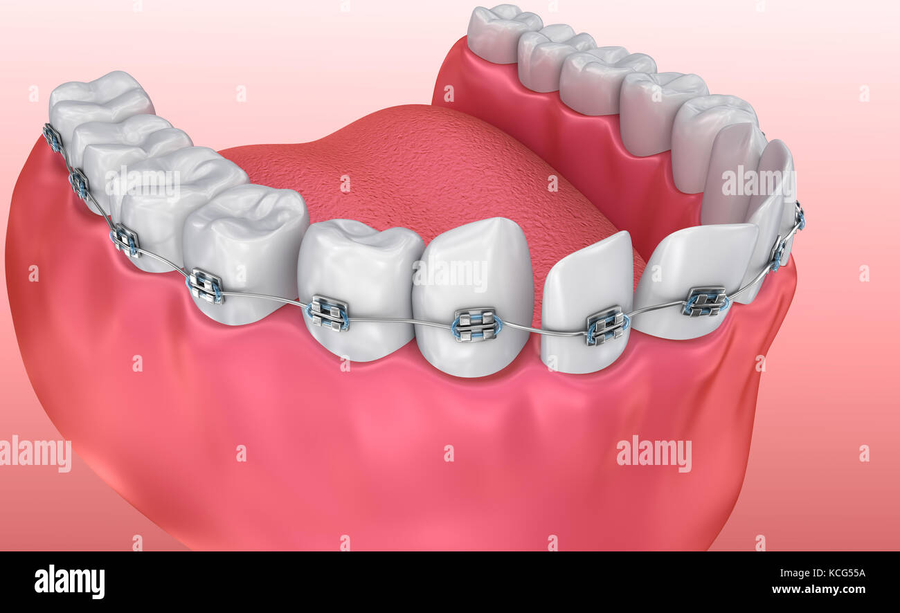Teeth with braces Alignment process. Medically accurate 3d illustration Stock Photo
