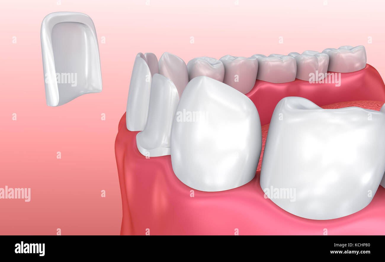 tooth veneers