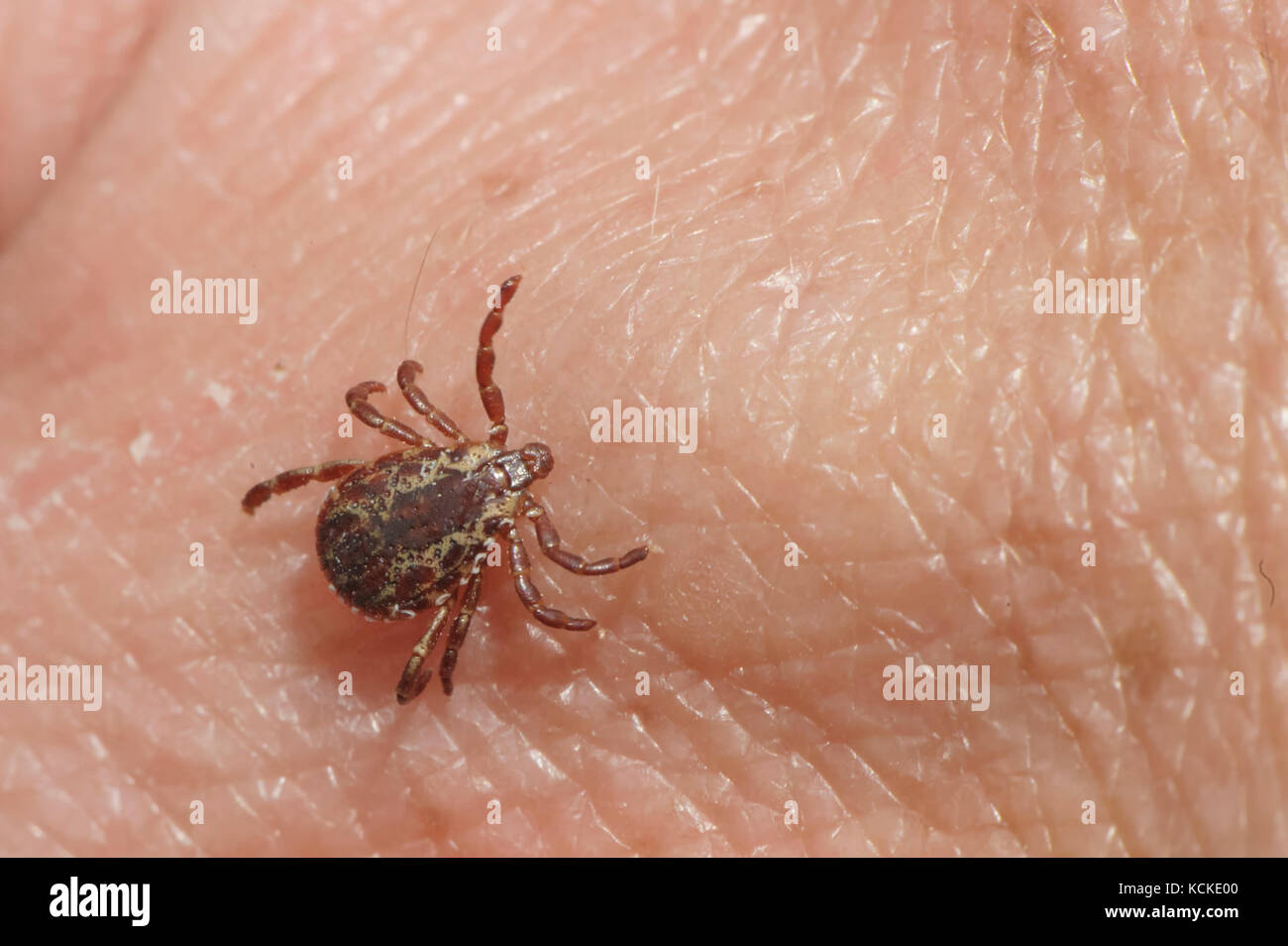 Tick on skin hires stock photography and images Alamy