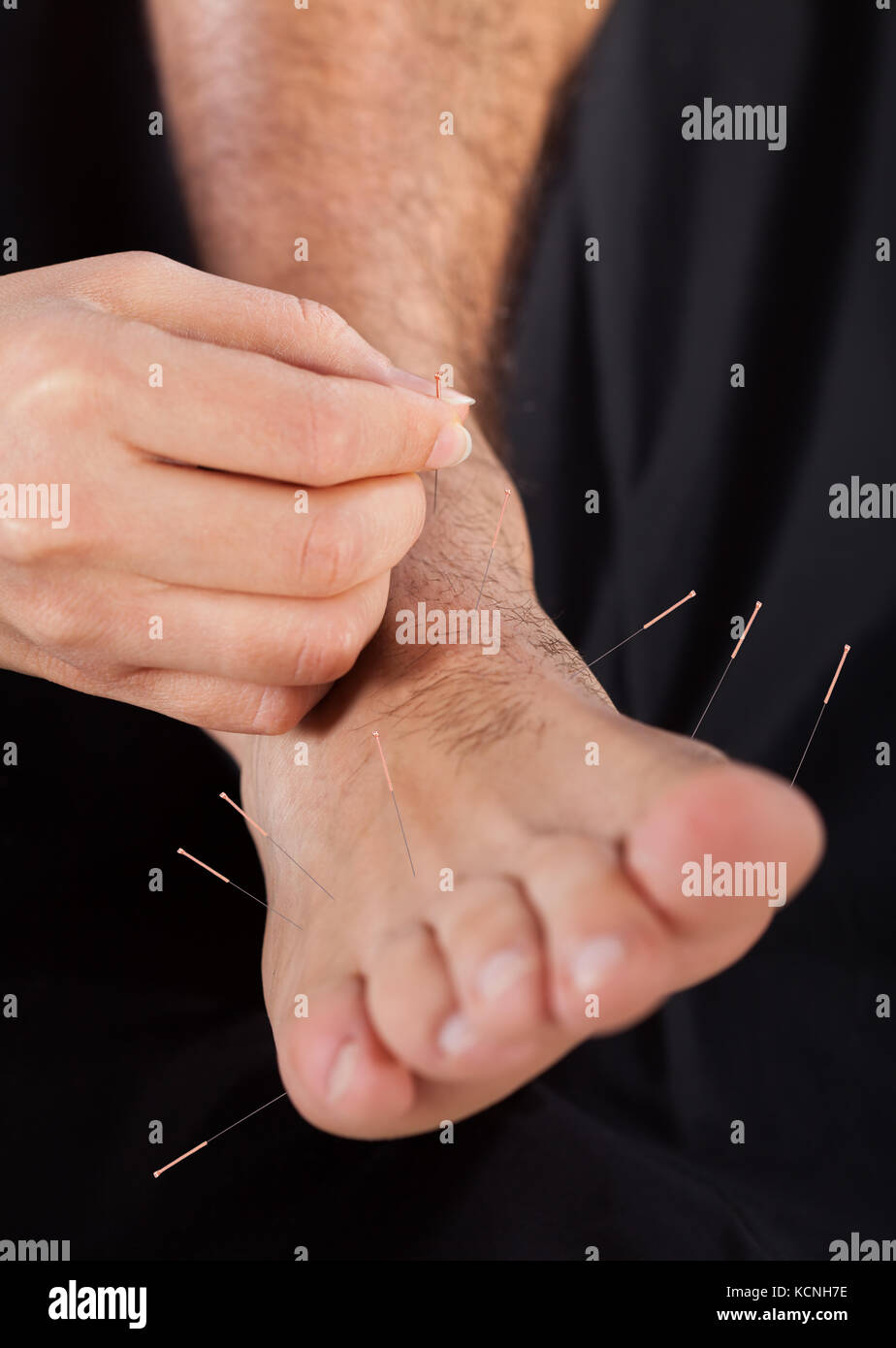 Close-up Of A Person's Leg Undergoing Acupuncture Treatment Stock Photo