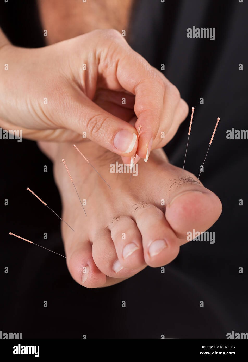 Closeup Of A Man's Feet Receiving Acupuncture Treatment Stock Photo