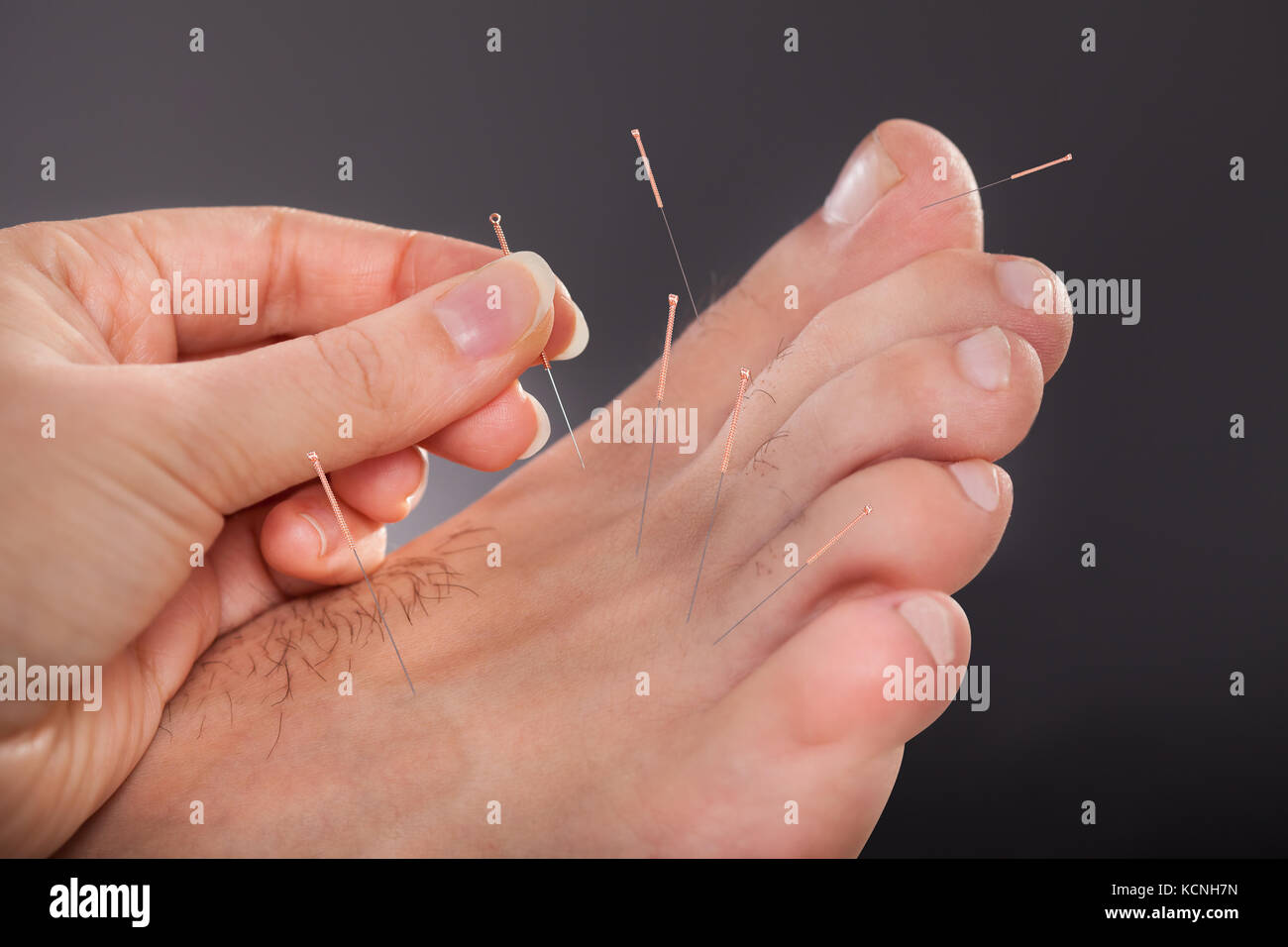 Closeup Of A Man's Feet Receiving Acupuncture Treatment Stock Photo