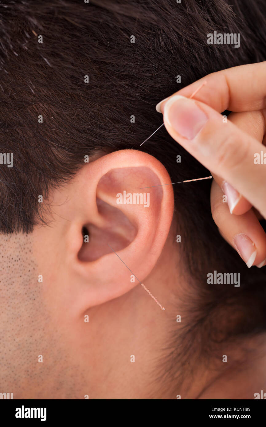 Acupuncturist hires stock photography and images Alamy