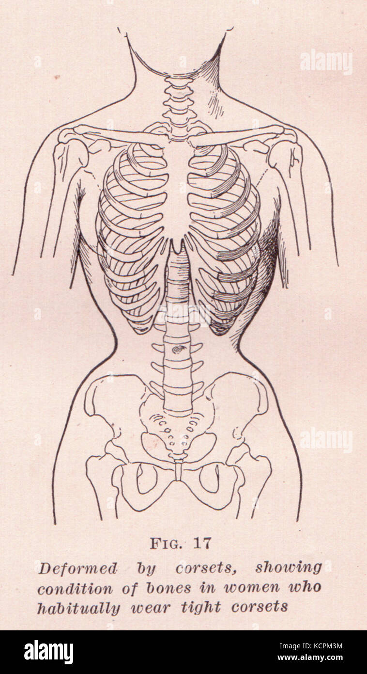 Effects of Corset Wearing Stock Photo Alamy